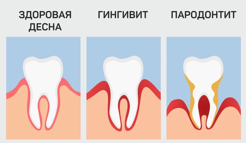Чем можно полоскать чувствительные зубы