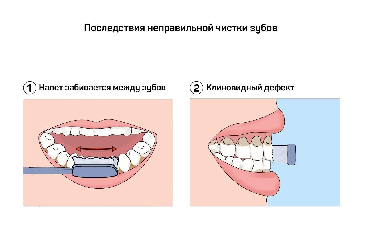 Чем отличается чистка зубов. Схема чистки зубов. Контролируемой чистки зубов.